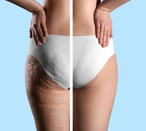 Collage with photos of woman before and after anti cellulite treatment on light blue background,